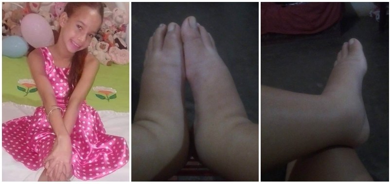 SÃO JULIÃO - Família realiza campanha para custear tratamento de saúde de adolescente que sofre com doença rara. saiba como ajudar