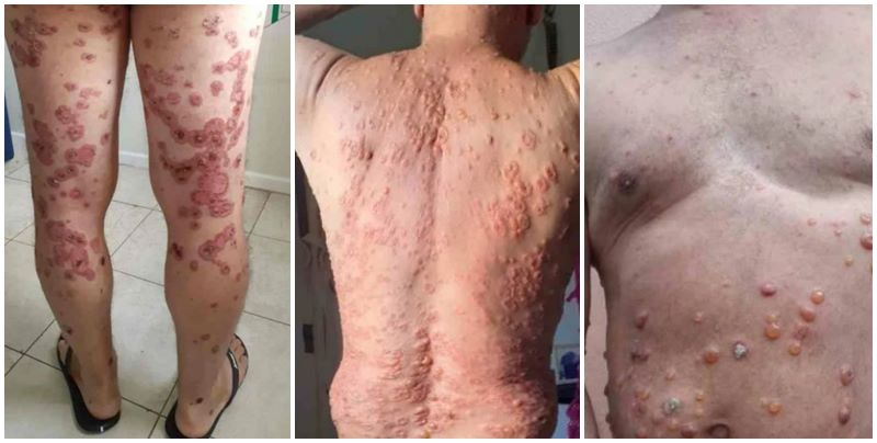 Após pegar Covid, homem desenvolve bolhas por todo o corpo no Piauí