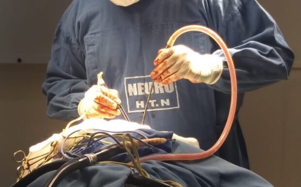 Sesapi realiza milésima cirurgia neurológica em Floriano